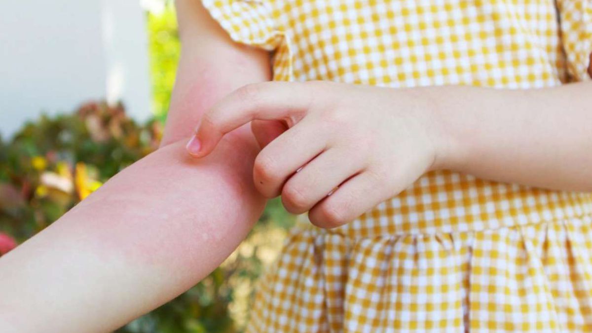 Her 5 çocuktan 1'inde alerji görülüyor