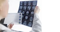 Alzheimer Tanısında Devrim: FDA Onaylı Kan Testiyle Erken Teşhis Mümkün